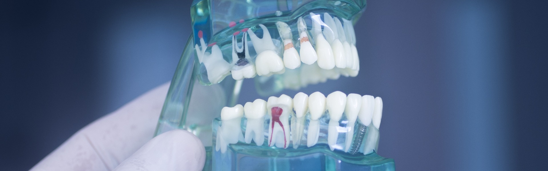 Tooth decay dental model jpg