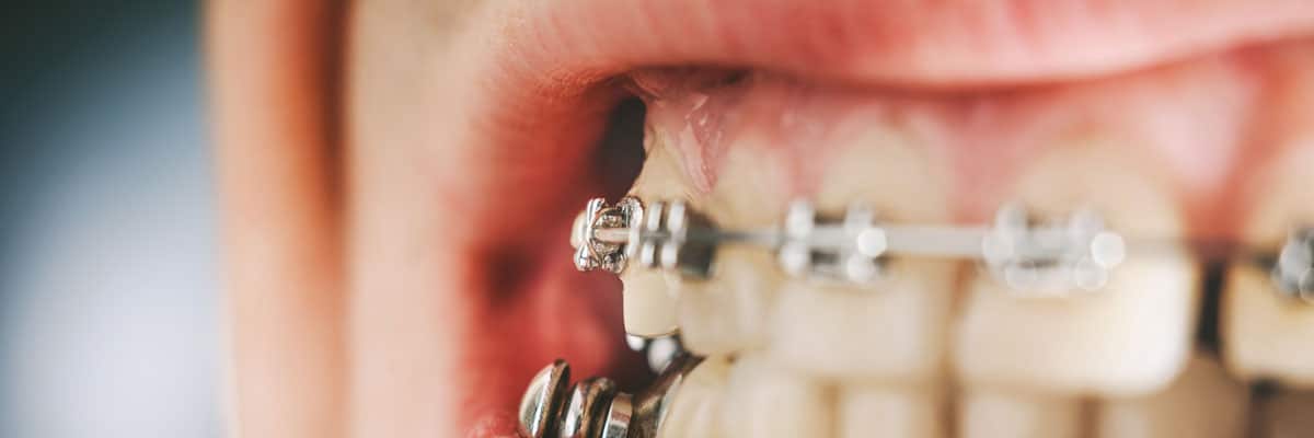Braces and dental appliance for deep bite