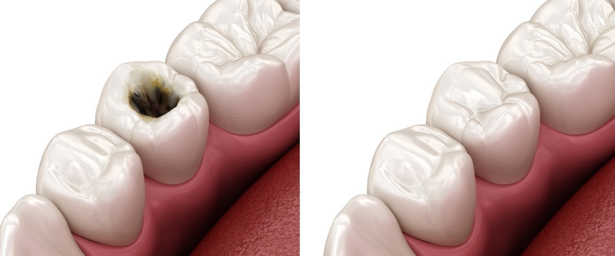 Vergleich zwischen einem gesunden Zahn und einem mit Karies